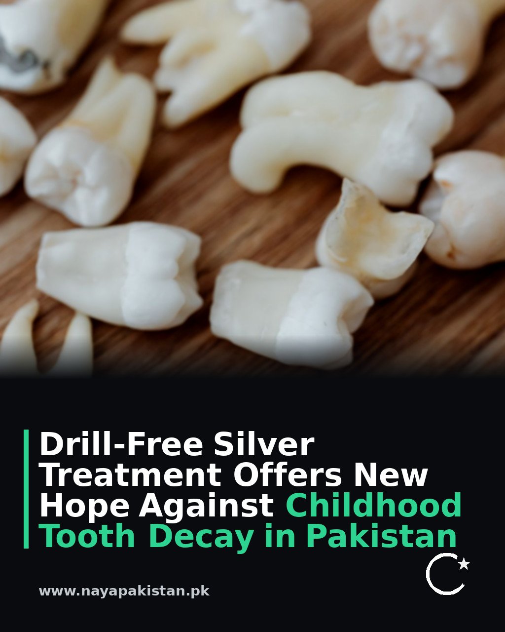 Drill-Free Silver Treatment Offers New Hope Against Childhood Tooth Decay in Pakistan