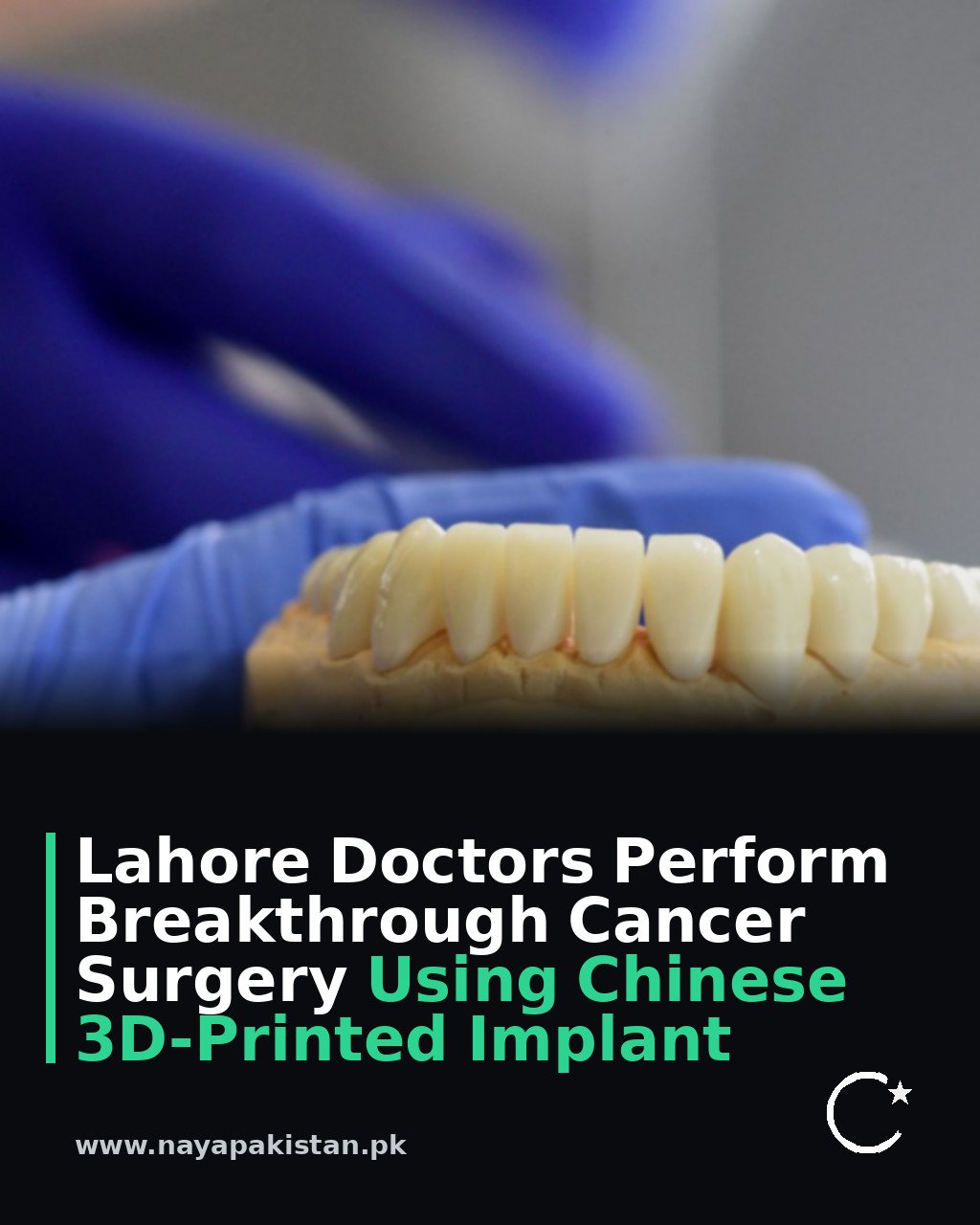 Lahore Doctors Perform Breakthrough Cancer Surgery Using Chinese 3D-Printed Implant